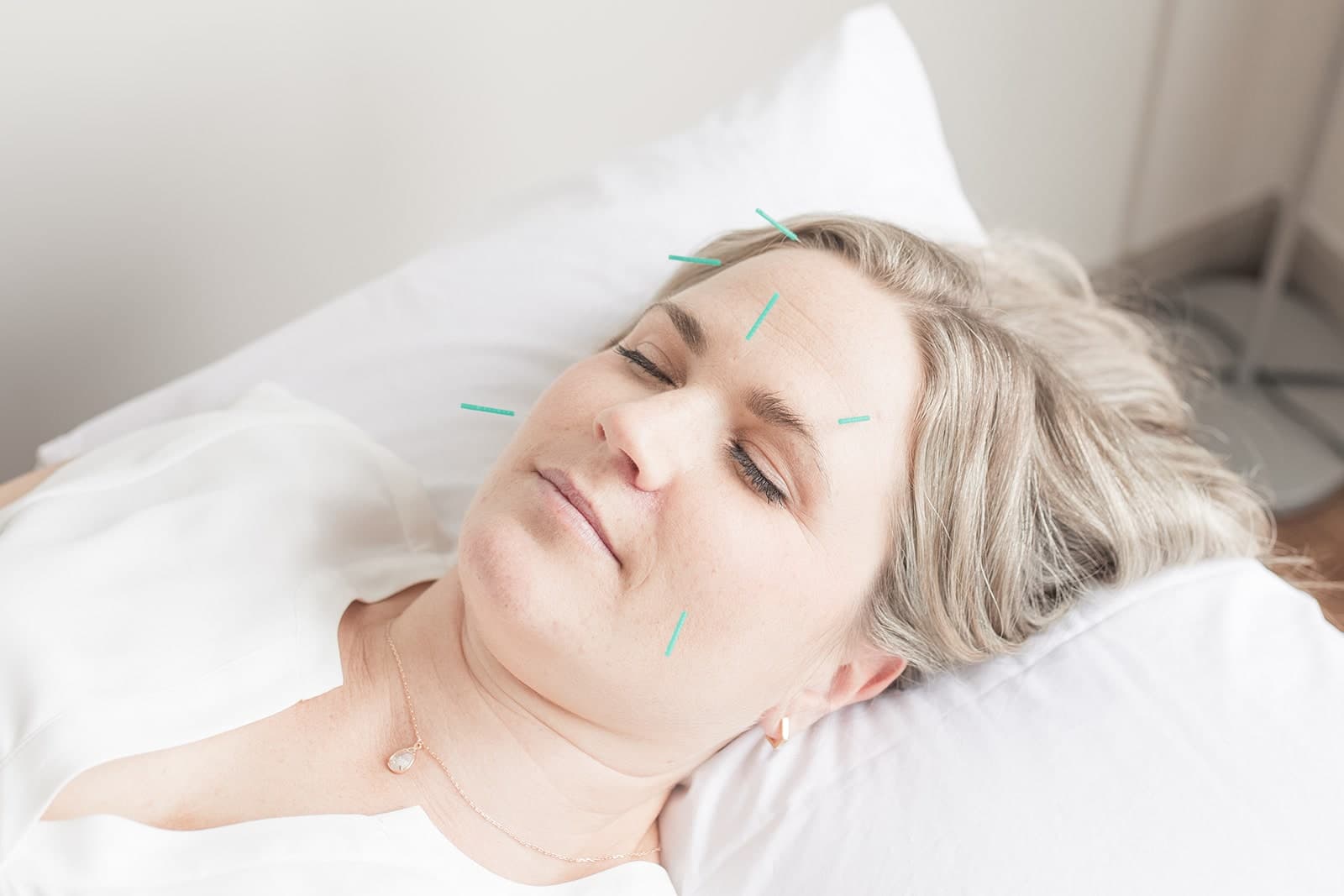 Patient lying on treatment table with eyes closed, marked with teal lines indicating facial rejuvenation acupuncture points on forehead and cheek