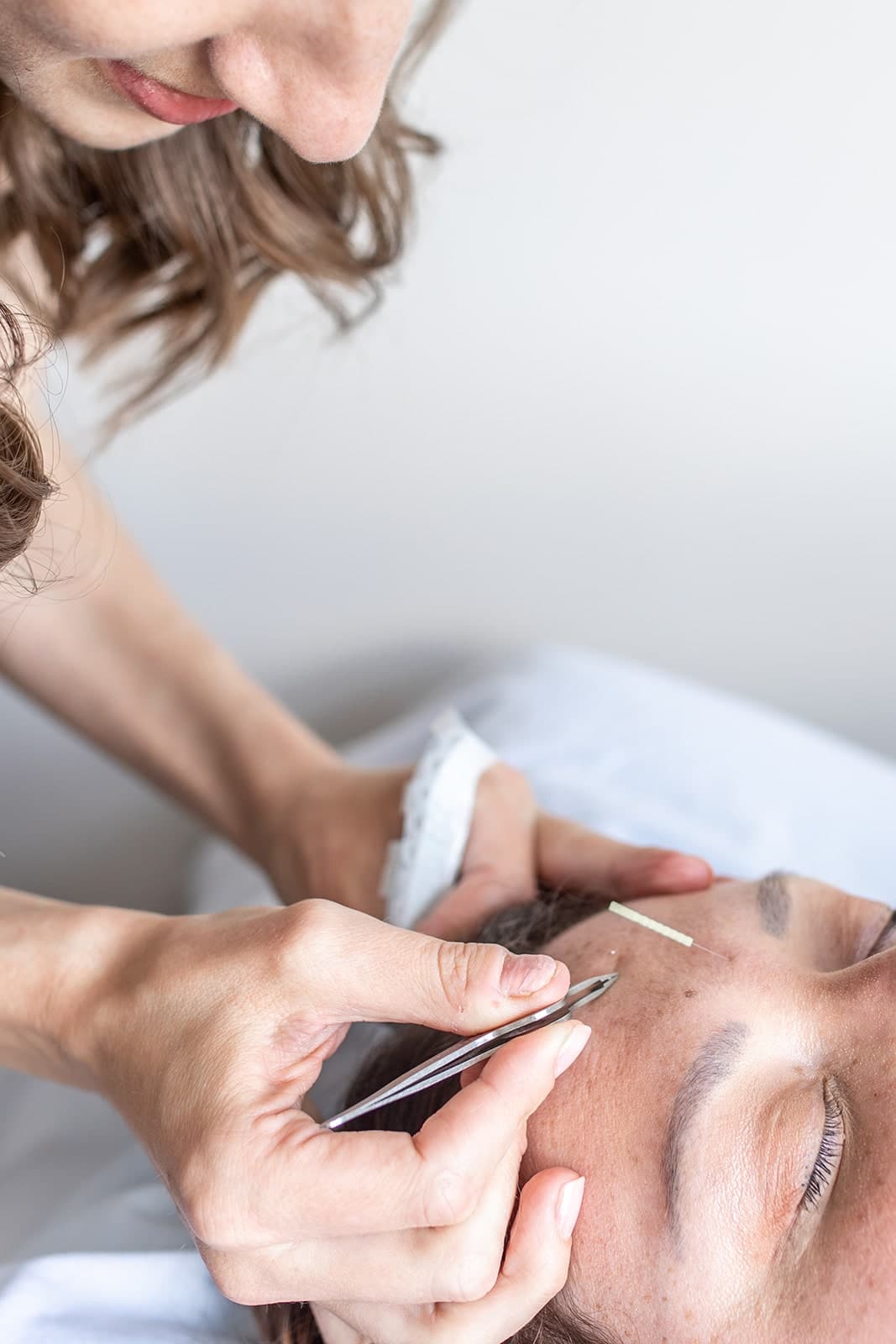 Practitioner placing an acupuncture needle near a patient's brow